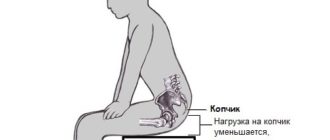 Болит копчик при сидении у женщины. Болит копчик при сидении. Болит копчик при вставании. Болит копчик при вставании из положения сидя. Ударился копчиком болит при сидении и вставании.